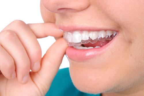 Chena Ridge affordable dental mouth guard